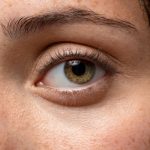 Sarı Nokta Hastalığı Nedir?